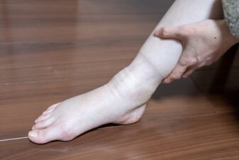 むくみでパンパンになった足のイメージ｜足もみで血流改善しスッキリ