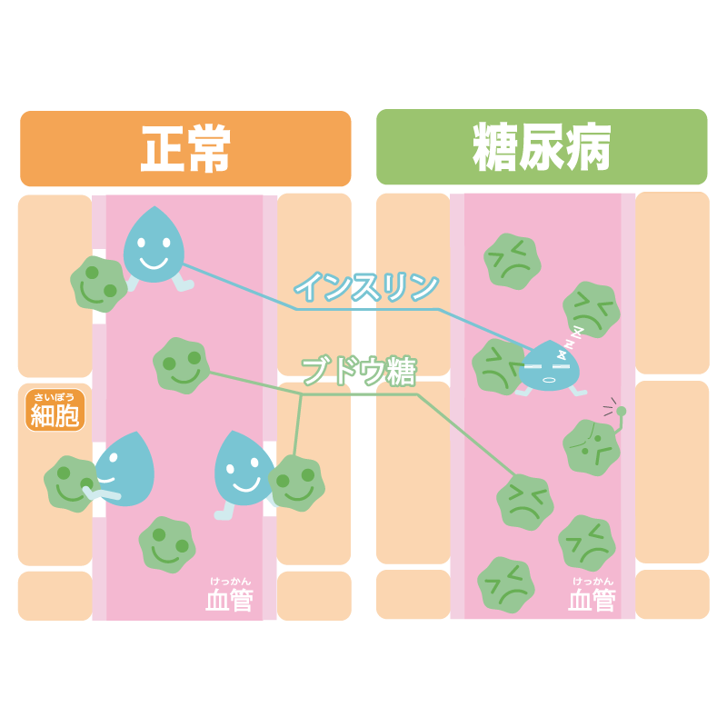 糖尿病とは？のイメージ