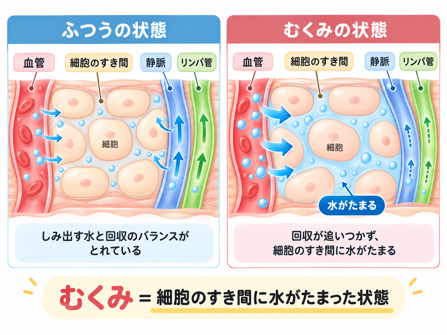 ふつうの状態と、細胞のすき間に水がたまったむくみの状態をくらべた図